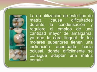 La no utilización de este tipo de 
matriz causa dificultades 
durante la condensación y 
requiere el empleo de una 
cantidad mayor de amalgama, 
ya que la cara lingual de los 
molares superiores tienen una 
inclinación acentuada hacia 
oclusal, donde difícilmente se 
consigue adaptar una matriz 
común. 
 