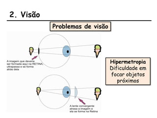 2. Visão
Problemas de visão
Hipermetropia
Dificuldade em
focar objetos
próximos
 