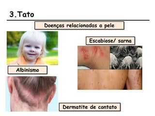 3.Tato
Doenças relacionadas a pele
Albinismo
Escabiose/ sarna
Dermatite de contato
 