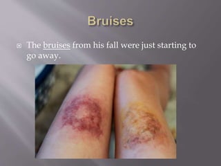  The bruises from his fall were just starting to
go away.
 