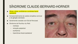 SÍNDROME CLAUDE-BERNARD-HORNER
■ Miose, ptose, enoftalmia e anidrose facial
ipsilateral
■ Comprometimento da cadeia simpática cervical
e do gânglio estrelado
■ Geralmente coexiste com Sd de Pancoast
■ Síndrome de Pourfour du Petit
– midríase
– retração palpebral
– exoftalmia
– hiperidrose facial ipsilateral
 