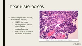 TIPOS HISTOLÓGICOS
■ Carcinoma pequenas células /
Avenocelular (oat cell)
– 15-20% dos casos
– pior prognóstico e maior
agressividade
– localização central
– possui 70% de chance de
metástase à distância
(INCA, 2022)
 