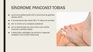 SÍNDROME PANCOAST-TOBIAS
■ carcinoma epidermoide (52%) carcinoma de grandes
células (23%)
■ O envolvimento das raízes C8 e T1 (ápice do pulmão)
■ dor no ombro e/ou escápula ipsilateral
■ dor na distribuição do nervo ulnar (com atrofia
muscular e paresia distal)
■ A destruição radiológica da primeira e segunda
costelas é comumente observada
 