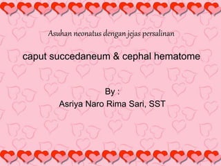 Asuhan neonatus dengan jejas persalinan
caput succedaneum & cephal hematome
By :
Asriya Naro Rima Sari, SST
 