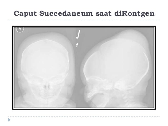 Caput Sucedaneum ppt