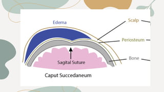 Caput succedaneum y cefalohematoma.pdf 12 | PDF