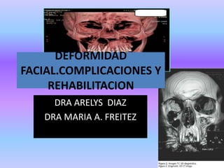 DEFORMIDAD
FACIAL.COMPLICACIONES Y
REHABILITACION
DRA ARELYS DIAZ
DRA MARIA A. FREITEZ
 