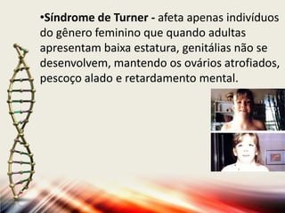 •Síndrome de Turner - afeta apenas indivíduos
do gênero feminino que quando adultas
apresentam baixa estatura, genitálias não se
desenvolvem, mantendo os ovários atrofiados,
pescoço alado e retardamento mental.

 