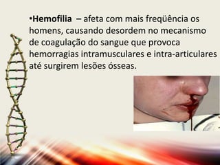 •Hemofilia – afeta com mais freqüência os
homens, causando desordem no mecanismo
de coagulação do sangue que provoca
hemorragias intramusculares e intra-articulares
até surgirem lesões ósseas.

 