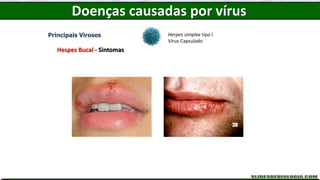 Doenças causadas por vírus
Principais Viroses
Hespes Bucal - Sintomas
Herpes simplex tipo I
Vírus Capsulado
 