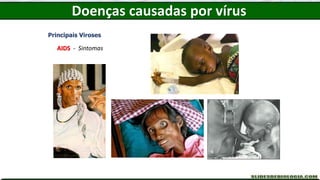 Doenças causadas por vírus
Principais Viroses
AIDS - Sintomas
 