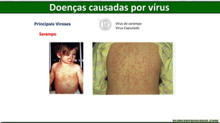 Doenças causadas por vírus
Principais Viroses
Sarampo
Vírus do sarampo
Vírus Capsulado
 
