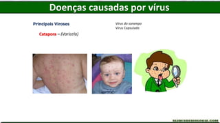 Doenças causadas por vírus
Principais Viroses
Catapora – (Varicela)
Vírus do sarampo
Vírus Capsulado
 