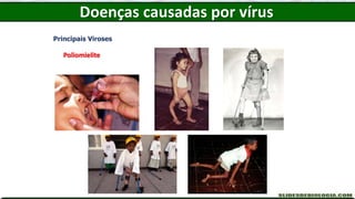 Doenças causadas por vírus
Principais Viroses
Poliomielite
 