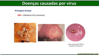 Doenças causadas por vírus
Principais Viroses
HPV – (Papiloma Vírus Humano)
Lesão causada pelo HPV na
parede do colo uterino
 