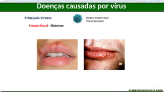 Doenças causadas por vírus
Principais Viroses
Hespes Bucal - Sintomas
Herpes simplex tipo I
Vírus Capsulado
 