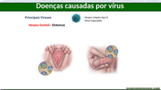 Doenças causadas por vírus
Principais Viroses
Hespes Genital - Sintomas
Herpes simplex tipo II
Vírus Capsulado
 