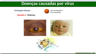 Doenças causadas por vírus
Principais Viroses
Hepatite A - Sintomas
Vírus da hepatite A
Vírus Capsulado
 