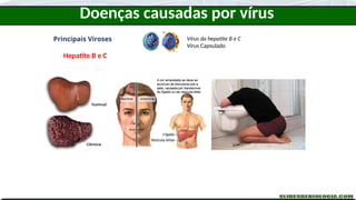 Doenças causadas por vírus
Principais Viroses
Hepatite B e C
Vírus da hepatite B e C
Vírus Capsulado
 