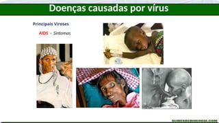 Doenças causadas por vírus
Principais Viroses
AIDS - Sintomas
 