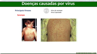 Doenças causadas por vírus
Principais Viroses
Sarampo
Vírus do sarampo
Vírus Capsulado
 
