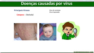 Doenças causadas por vírus
Principais Viroses
Catapora – (Varicela)
Vírus do sarampo
Vírus Capsulado
 