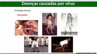 Doenças causadas por vírus
Principais Viroses
Poliomielite
 