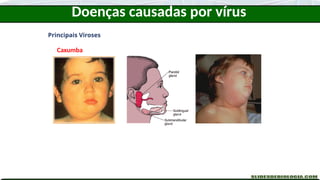 Doenças causadas por vírus
Principais Viroses
Caxumba
 