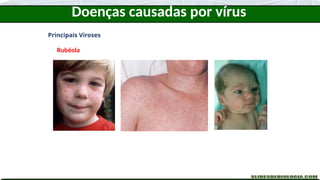 Doenças causadas por vírus
Principais Viroses
Rubéola
 