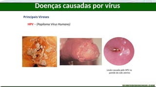 Doenças causadas por vírus
Principais Viroses
HPV – (Papiloma Vírus Humano)
Lesão causada pelo HPV na
parede do colo uterino
 