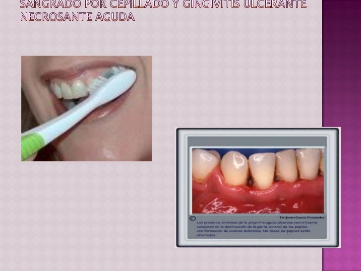 Caracteristicas Clinicas De La Gingivitis