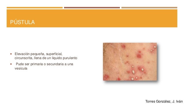 46+ Cicatriz Atrofica Caracteristicas Pictures