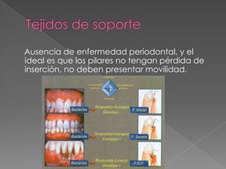 Ausencia de enfermedad periodontal, y el
ideal es que los pilares no tengan pérdida de
inserción, no deben presentar movilidad.
 