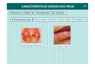 CARACTERÍSTICAS GERAIS DOS VÍRUSCARACTERÍSTICAS GERAIS DOS VÍRUS 3131
Transmissão Oral:
PRINCIPAIS FORMAS DE TRANSMISSÃO DAS VIROSES:
Mononucleose Infecciosa, Herpes Labial, Citomegalovírus
Herpes LabialMononucleose Infecciosa
 