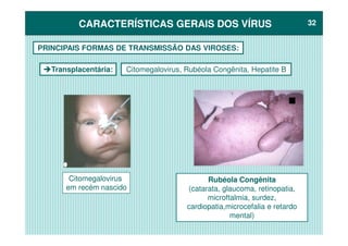 CARACTERÍSTICAS GERAIS DOS VÍRUSCARACTERÍSTICAS GERAIS DOS VÍRUS 3232
Transplacentária:
PRINCIPAIS FORMAS DE TRANSMISSÃO DAS VIROSES:
Citomegalovirus, Rubéola Congênita, Hepatite B
Rubéola Congênita
(catarata, glaucoma, retinopatia,
microftalmia, surdez,
cardiopatia,microcefalia e retardo
mental)
Citomegalovirus
em recém nascido
 