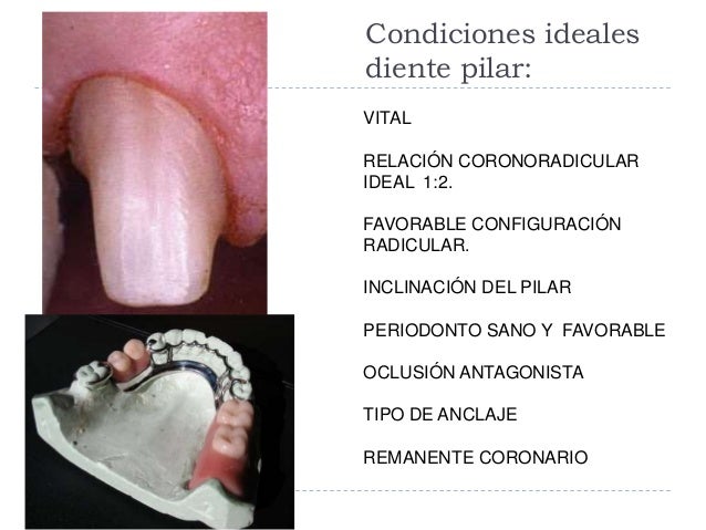 pubertad Es decir muy diente pilar protesis parcial removible Chelín