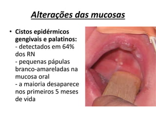 Alterações das mucosas
• Cistos epidérmicos
gengivais e palatinos:
- detectados em 64%
dos RN
- pequenas pápulas
branco-amareladas na
mucosa oral
- a maioria desaparece
nos primeiros 5 meses
de vida
 