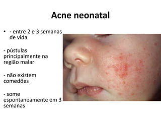 Acne neonatal
• - entre 2 e 3 semanas
de vida
- pústulas
principalmente na
região malar
- não existem
comedões
- some
espontaneamente em 3
semanas
 