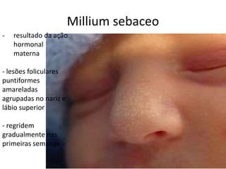 Millium sebaceo
- resultado da ação
hormonal
materna
- lesões foliculares
puntiformes
amareladas
agrupadas no nariz e
lábio superior
- regridem
gradualmente nas
primeiras semanas
 