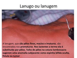 Lanugo ou lanugem
A lanugem, que são pêlos finos, macios e imaturos, são
encontrados nos prematuros. Nos lactentes a termo ela é
substituída por pêlos. Tufos de pêlos na coluna lombossacra
sugerem uma anomalia subjacente como espinha bífida oculta,
fístula ou tumor
 