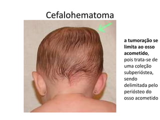 Cefalohematoma
a tumoração se
limita ao osso
acometido,
pois trata-se de
uma coleção
subperióstea,
sendo
delimitada pelo
periósteo do
osso acometido
 