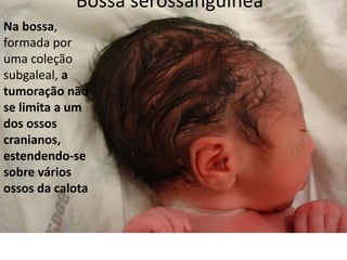 Bossa serossanguinea
Na bossa,
formada por
uma coleção
subgaleal, a
tumoração não
se limita a um
dos ossos
cranianos,
estendendo-se
sobre vários
ossos da calota
 
