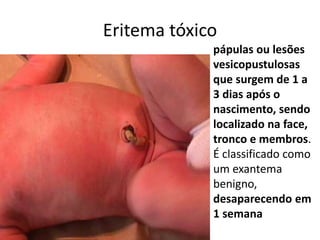 Eritema tóxico
pápulas ou lesões
vesicopustulosas
que surgem de 1 a
3 dias após o
nascimento, sendo
localizado na face,
tronco e membros.
É classificado como
um exantema
benigno,
desaparecendo em
1 semana
 