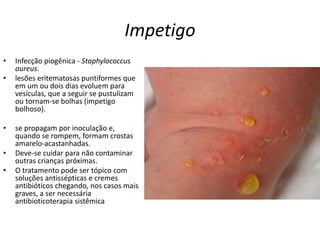 Impetigo
• Infecção piogênica - Staphylococcus
aureus.
• lesões eritematosas puntiformes que
em um ou dois dias evoluem para
vesículas, que a seguir se pustulizam
ou tornam-se bolhas (impetigo
bolhoso).
• se propagam por inoculação e,
quando se rompem, formam crostas
amarelo-acastanhadas.
• Deve-se cuidar para não contaminar
outras crianças próximas.
• O tratamento pode ser tópico com
soluções antissépticas e cremes
antibióticos chegando, nos casos mais
graves, a ser necessária
antibioticoterapia sistêmica
 