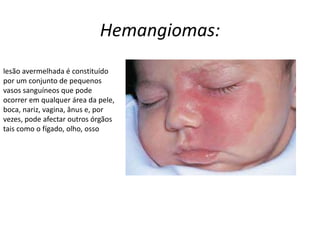Hemangiomas:
lesão avermelhada é constituído
por um conjunto de pequenos
vasos sanguíneos que pode
ocorrer em qualquer área da pele,
boca, nariz, vagina, ânus e, por
vezes, pode afectar outros órgãos
tais como o fígado, olho, osso
 