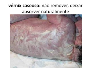vérnix caseoso: não remover, deixar
absorver naturalmente
 