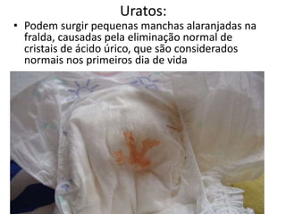 Uratos:
• Podem surgir pequenas manchas alaranjadas na
fralda, causadas pela eliminação normal de
cristais de ácido úrico, que são considerados
normais nos primeiros dia de vida
 