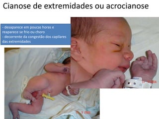 Cianose de extremidades ou acrocianose
- desaparece em poucas horas e
reaparece se frio ou choro
- decorrente da congestão dos capilares
das extremidades
 