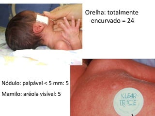 Orelha: totalmente
encurvado = 24
Nódulo: palpável < 5 mm: 5
Mamilo: aréola visível: 5
 