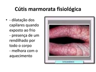 Cútis marmorata fisiológica
• - dilatação dos
capilares quando
exposto ao frio
- presença de um
rendilhado por
todo o corpo
- melhora com o
aquecimento
 